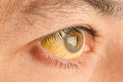 Hepatitis, yellow eyes